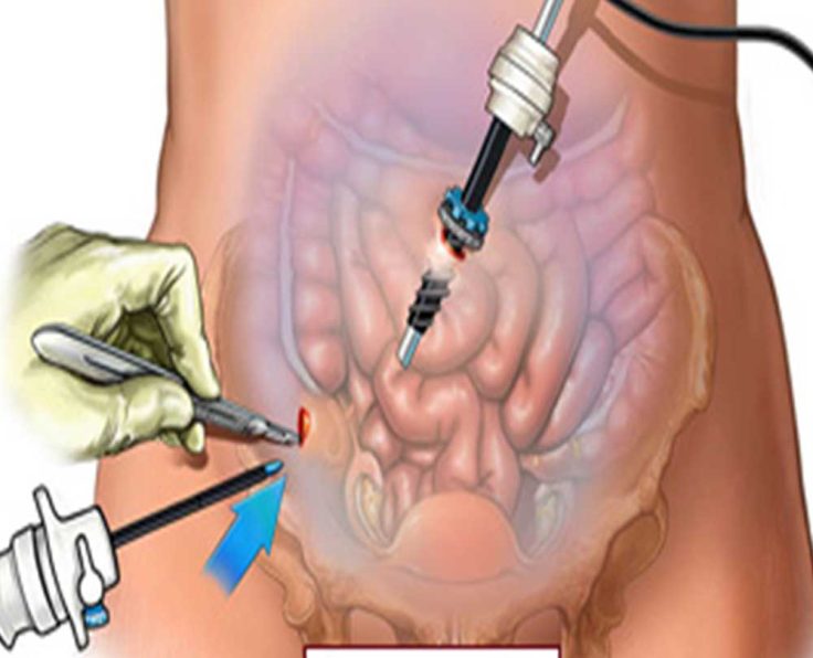 Gynecologic-Laparoscopic-Surger